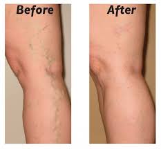 beforeafterveins