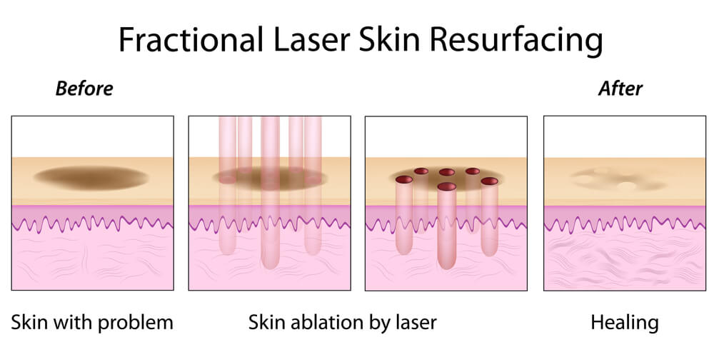 fractional laser