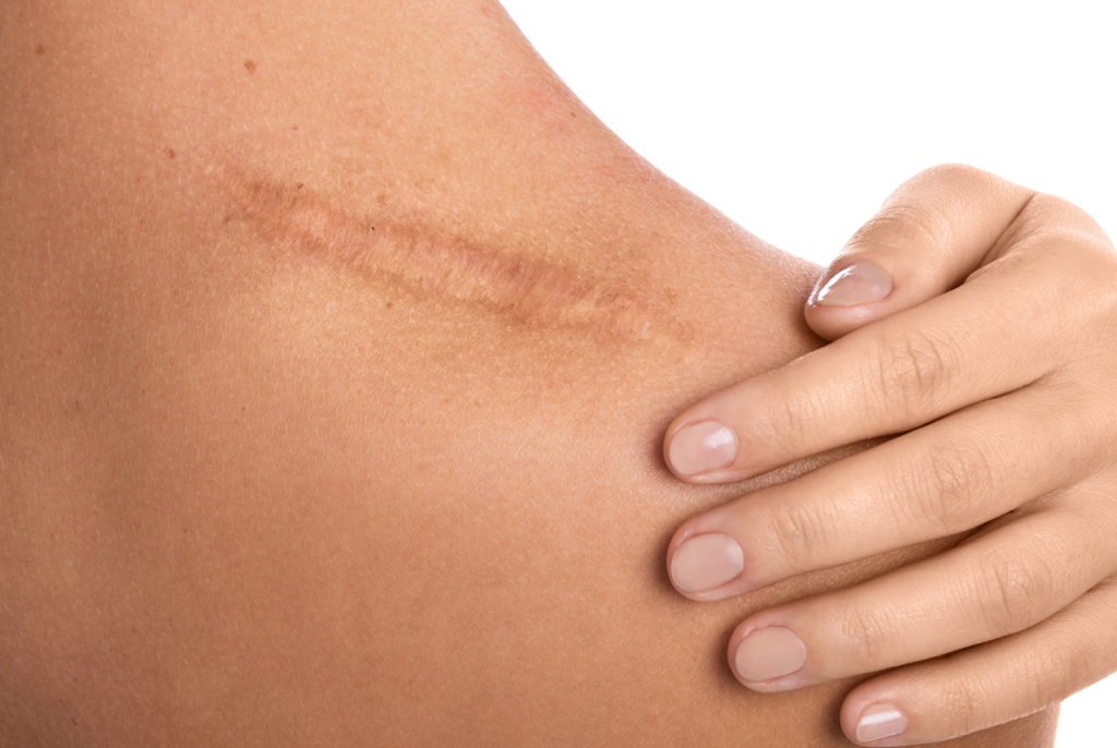 Scar reduction treatment with lasers and microneedling at Dr Bhabha Aesthetics